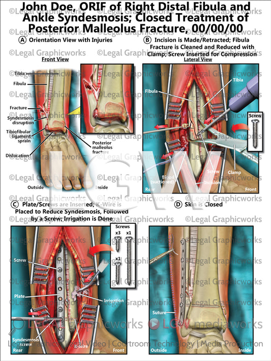 ORIF of Right Distal Fibula and Ankle Syndesmosis; Closed Treatment of Posterior Malleolus Fracture