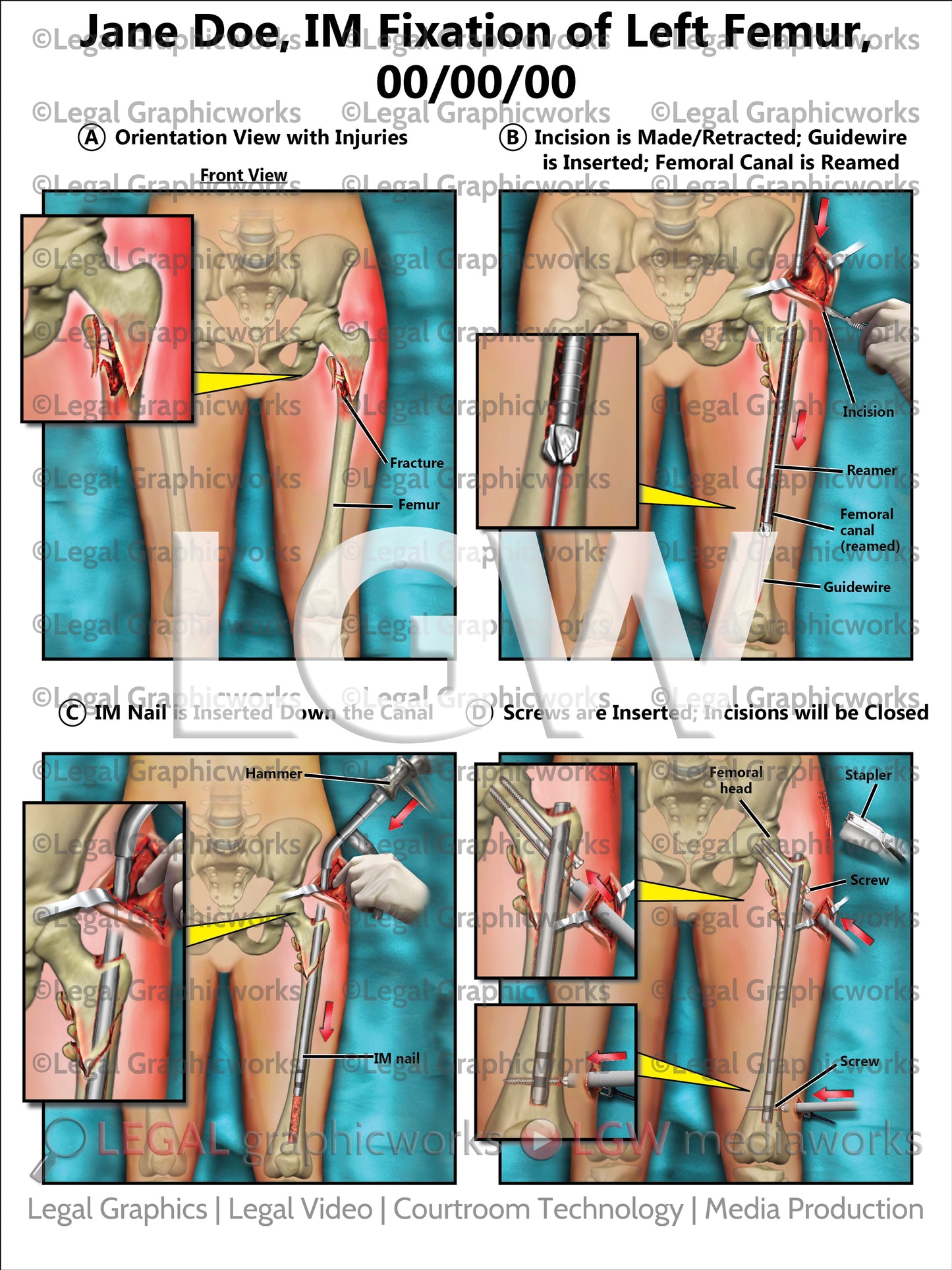 IM Fixation of Left Femur