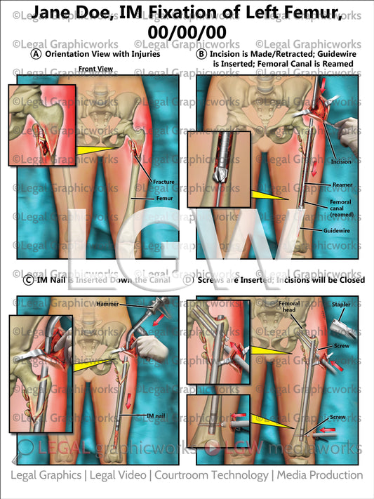 IM Fixation of Left Femur