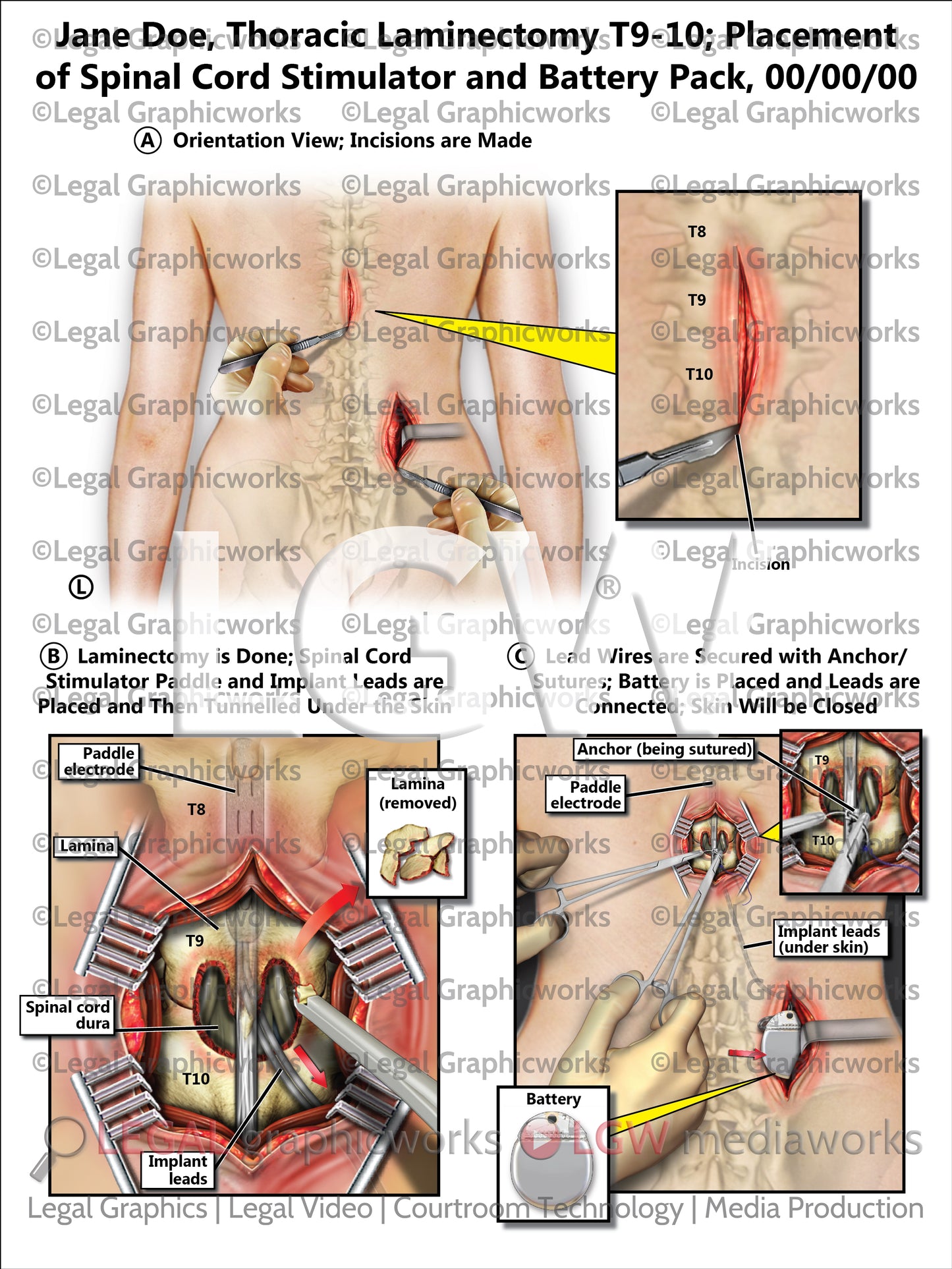 Thoracic Laminectomy T9-10; Placement of Spinal Cord Stimulator and Battery Pack
