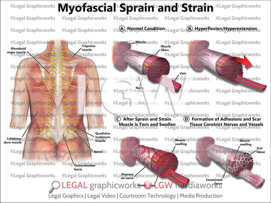 Myofascial Sprain and Strain