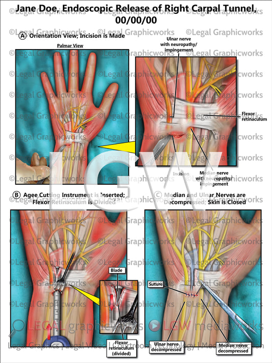 Endoscopic Release of Right Carpal Tunnel