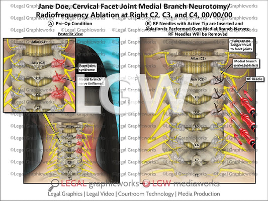 Cervical Facet Joint Medial Branch Neurotomy/Radiofrequency Ablation at Right C2, C3, and C4
