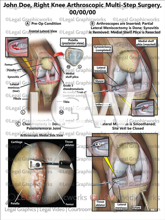 Right Knee Arthroscopic Multi-Step Surgery