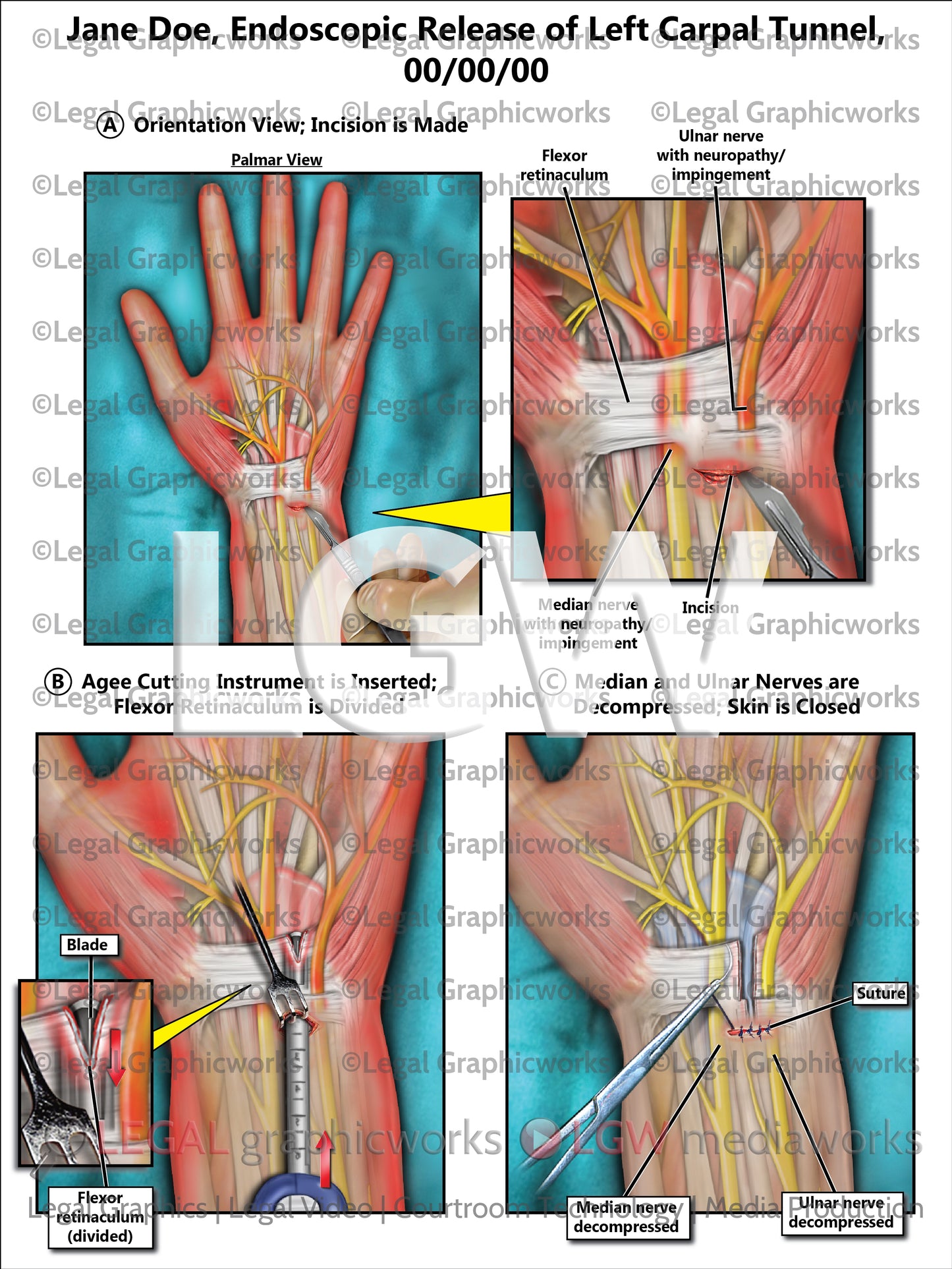 Endoscopic Release of Left Carpal Tunnel