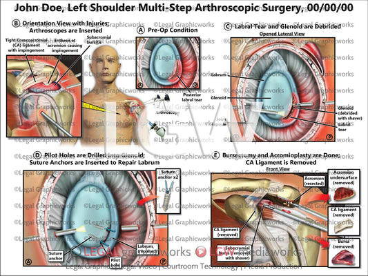 Left Shoulder Multi-Step Arthroscopic Surgery