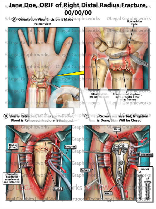 ORIF of Right Distal Radius Fracture