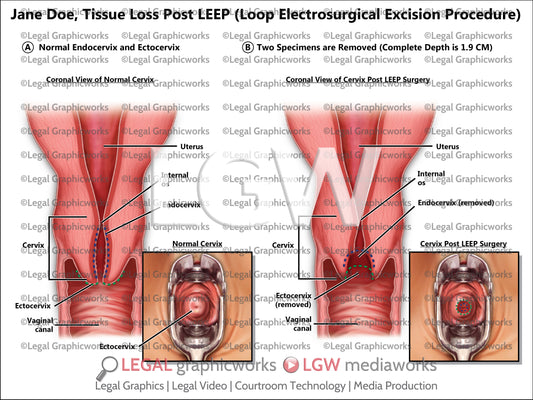 Tissue Loss Post LEEP (Loop Electrosurgical Excision Procedure)