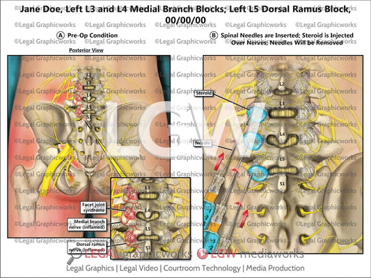 Left L3 and L4 Medial Branch Blocks; Left L5 Dorsal Ramus Block