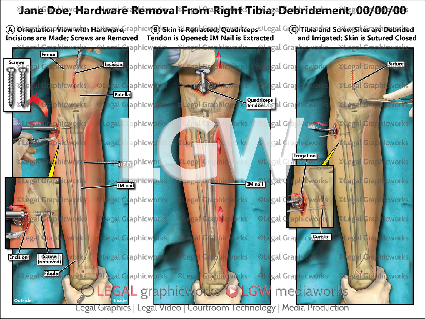 Hardware Removal From Right Tibia; Debridement