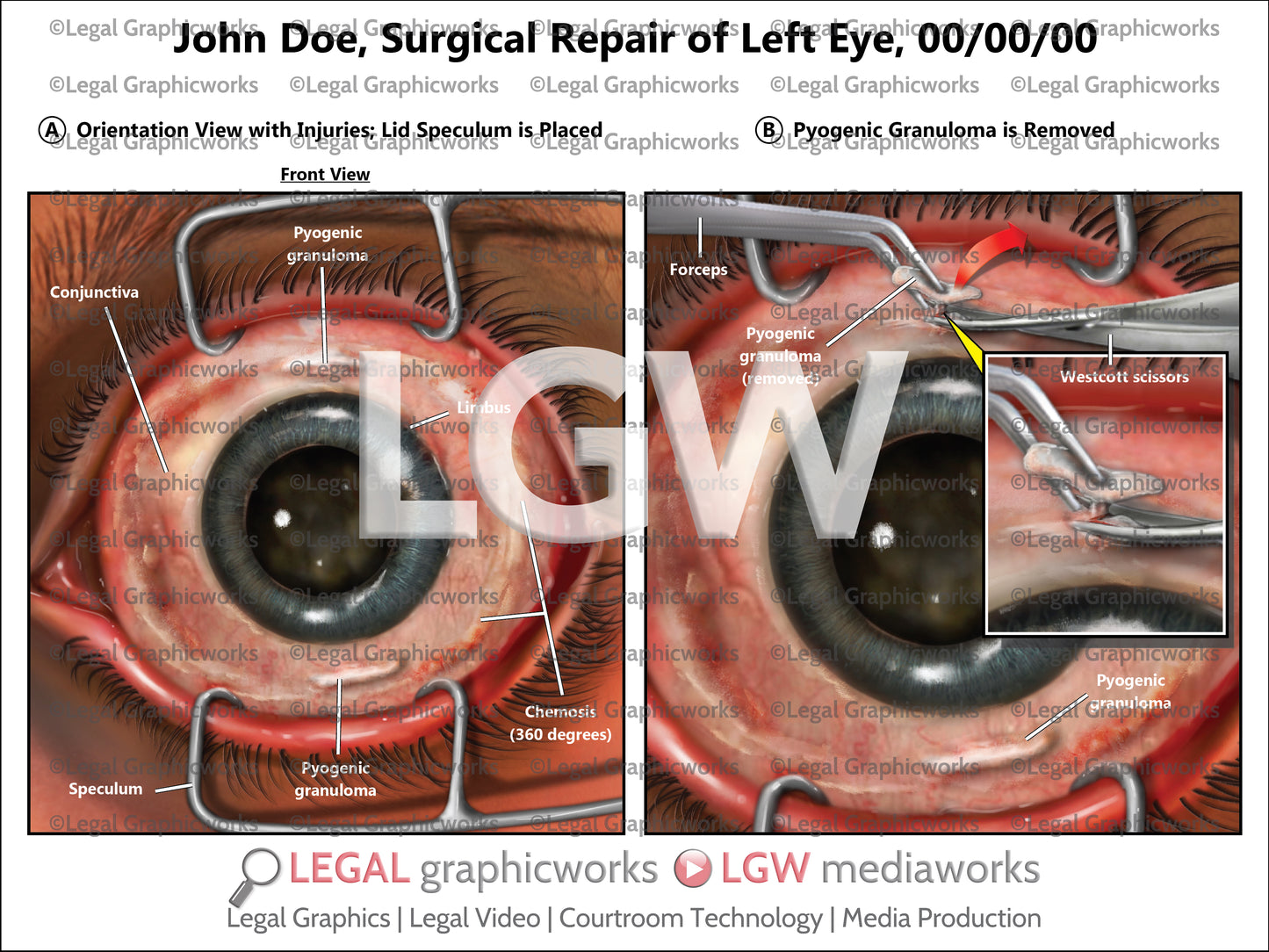 Surgical Repair of Left Eye