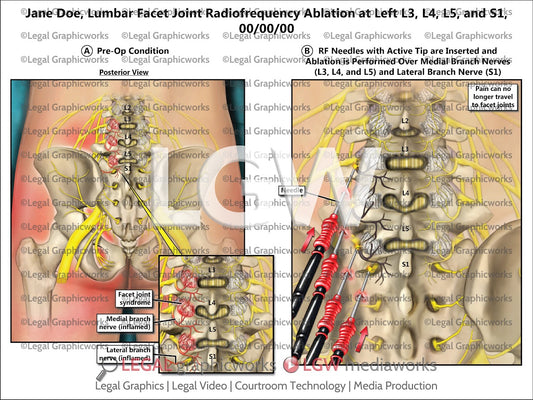 Lumbar Facet Joint Radiofrequency Ablation at Left L3, L4, L5, and S1