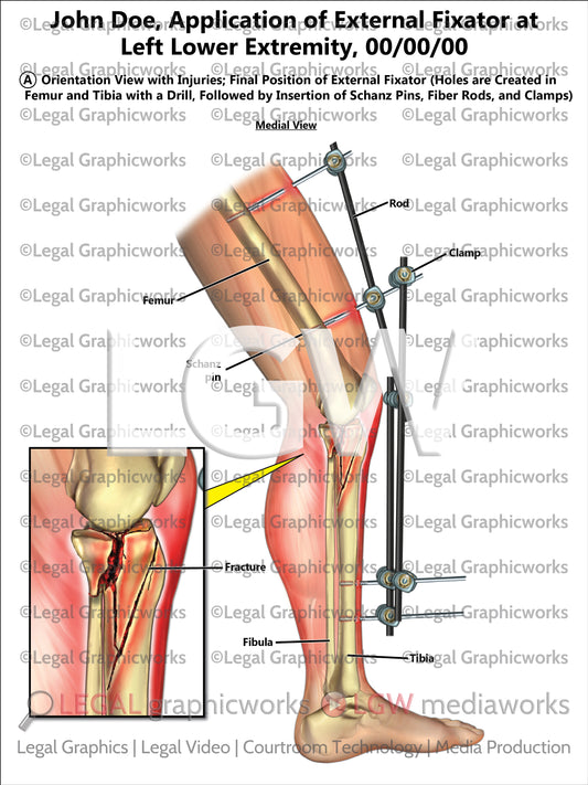 Application of External Fixator at Left Lower Extremity