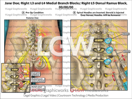 Right L3 and L4 Medial Branch Blocks; Right L5 Dorsal Ramus Block