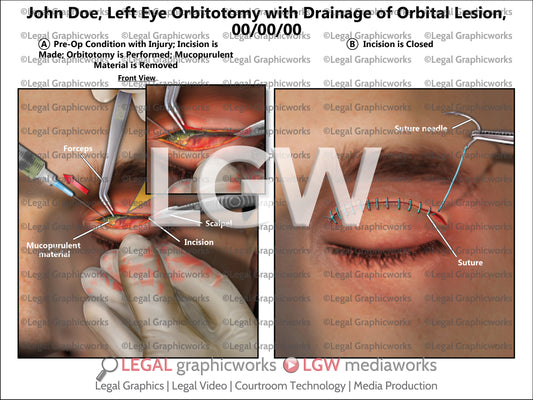 Left Eye Orbitotomy with Drainage or Orbital Lesion