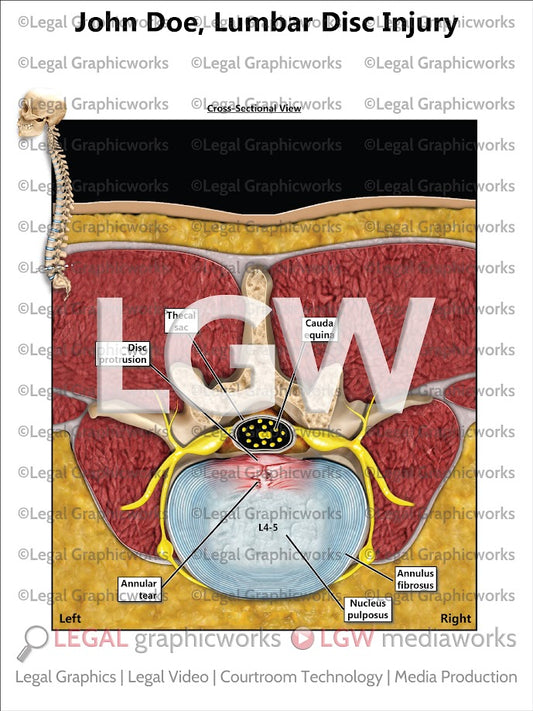 Lumbar Disc Injury