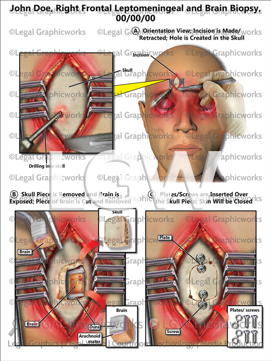 Right Frontal Leptomeningeal and Brain Biopsy