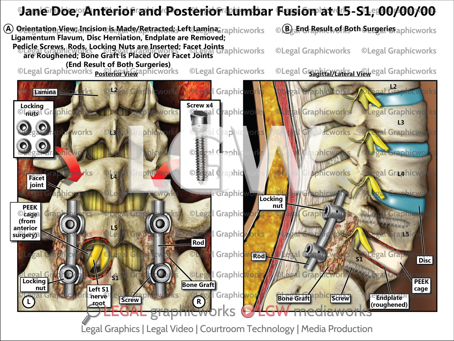 Anterior and Posterior Lumbar Fusion at L5-S1