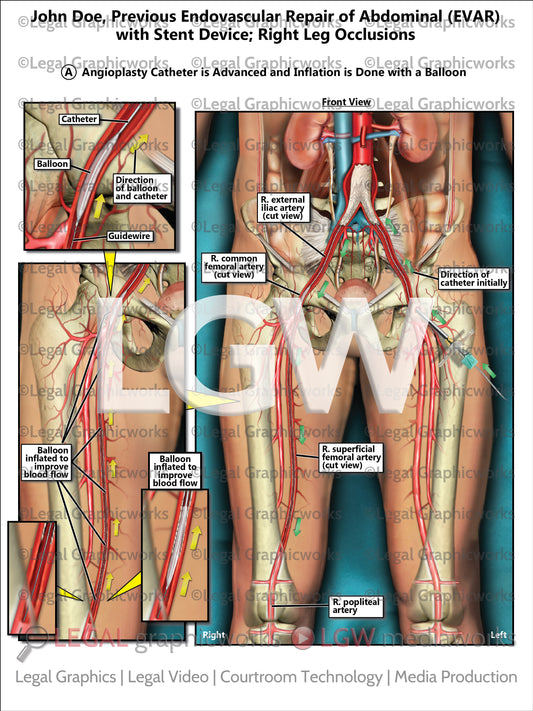 Previous Endovascular Repair of Abdominal (EVAR) with Stent Device; Right Leg Occlusions