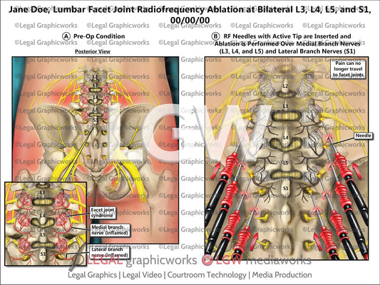 Lumbar Facet Joint Radiofrequency Ablation at Bilateral L3, L4, L5, and S1
