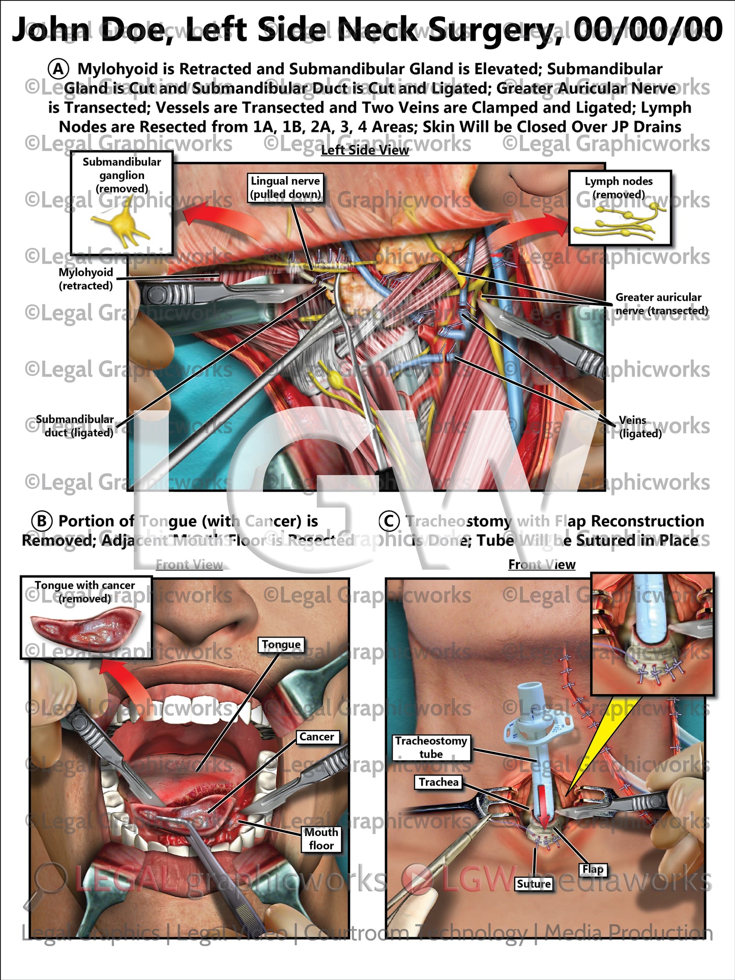 Left Side Neck Surgery