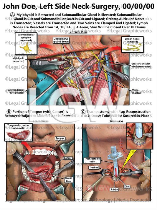 Left Side Neck Surgery