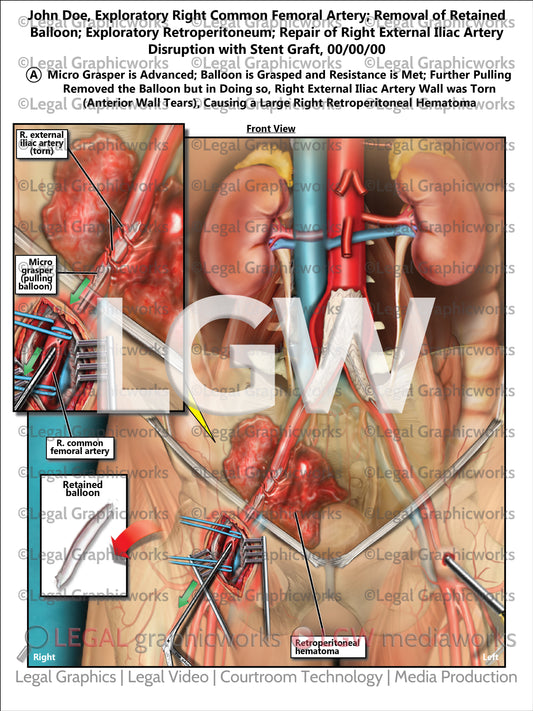 Exploratory Right Common Femoral Artery; Removal of Retained Balloon; Exploratory Retroperitoneum; Repair of Right External Iliac Artery Disruption with Stent Graft