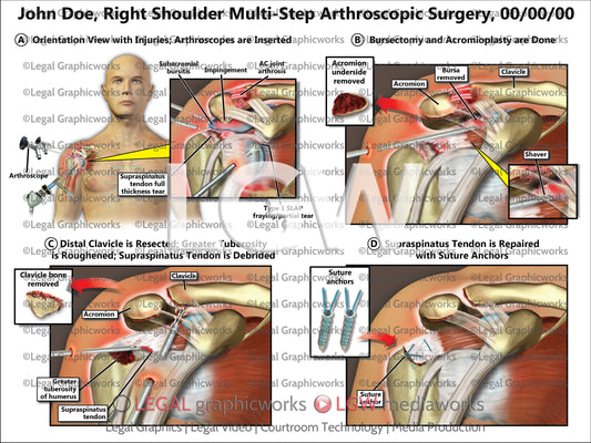 Right Shoulder Multi-Step Arthroscopic Surgery