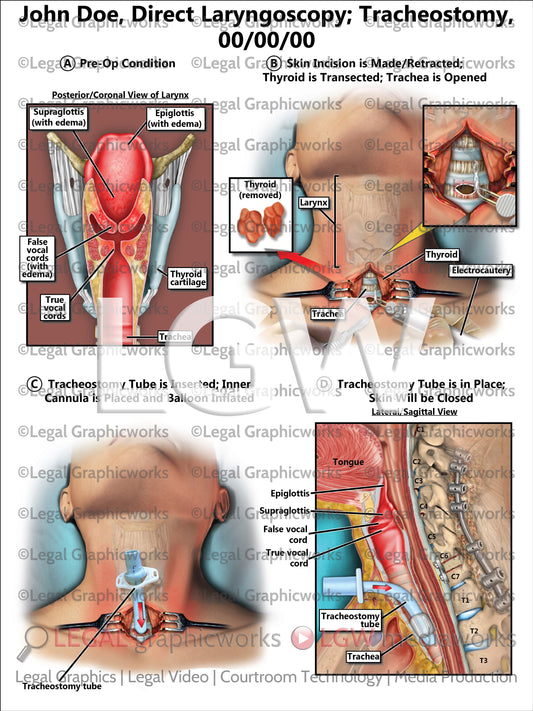 Direct Laryngoscopy; Tracheostomy
