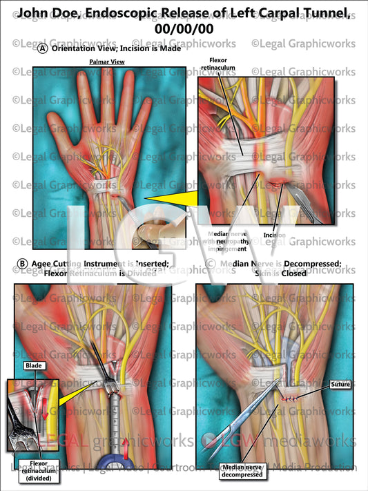 Endoscopic Release of Left Carpal Tunnel