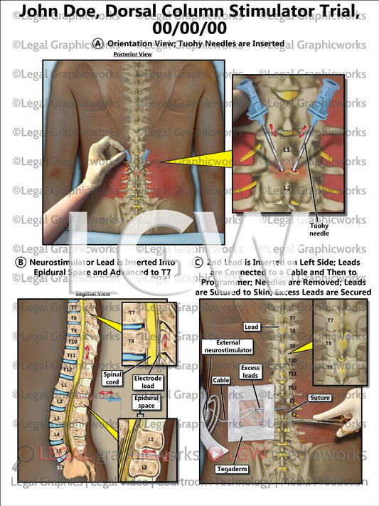 Dorsal Column Stimulator Trial