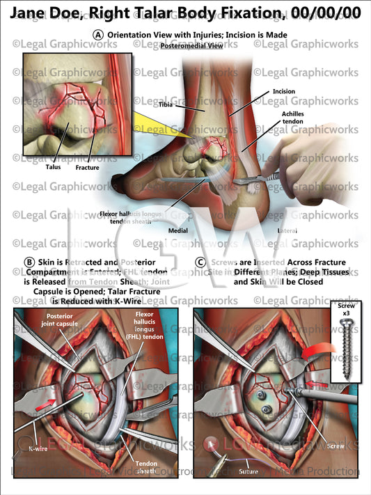 Right Talar Body Fixation