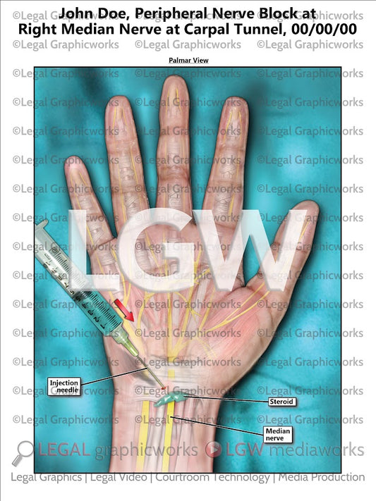 Peripheral Nerve Block at Right Median Nerve at Carpal Tunnel