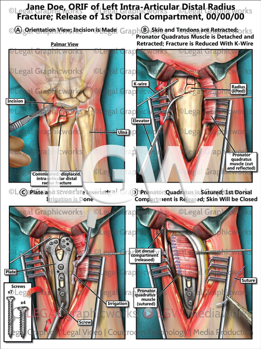 ORIF of Left Intra-Articular Distal Radius Fracture; Release of 1st Dorsal Compartment
