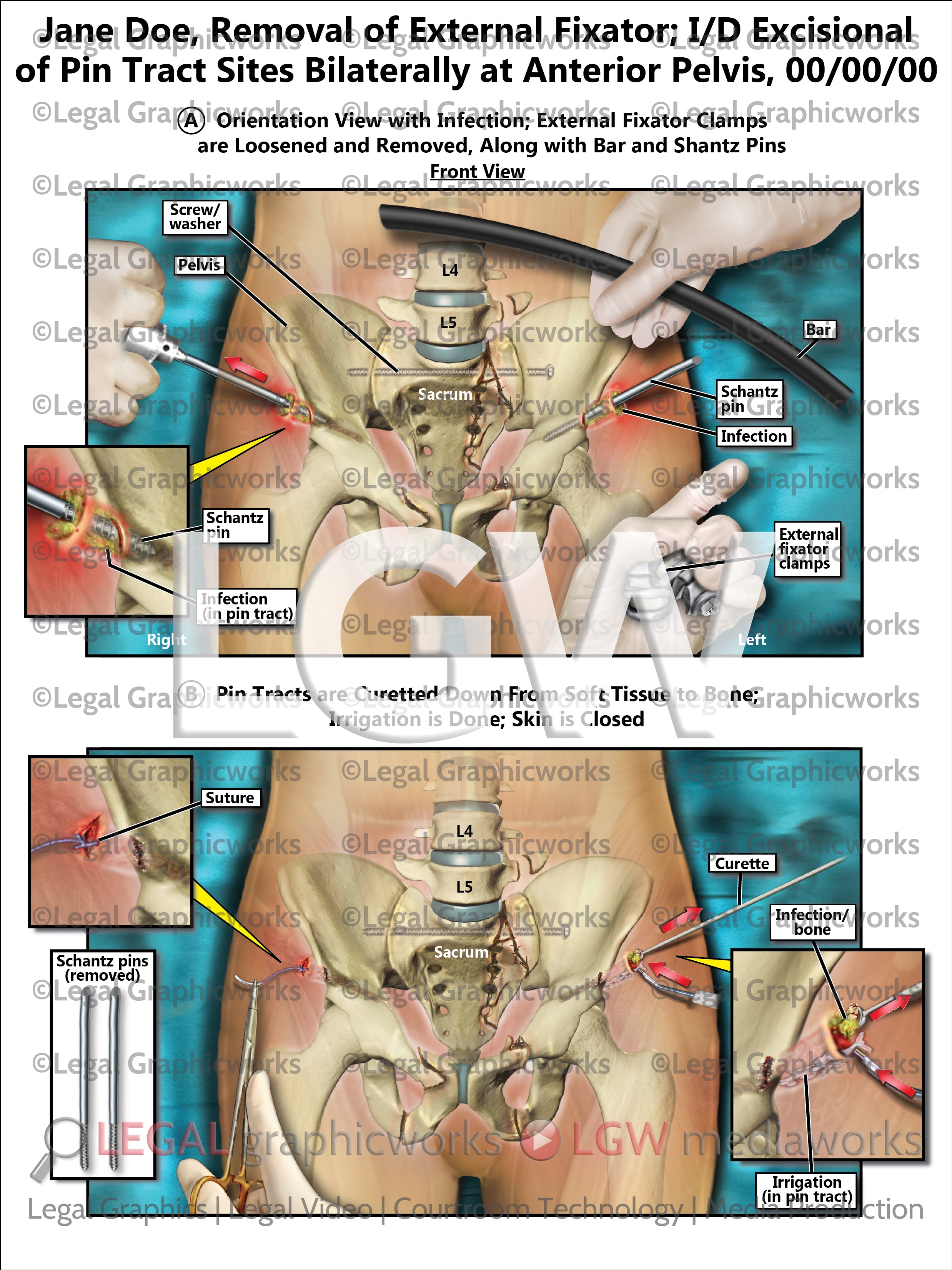 Exfixater Removal of External Fixator; I/D Excisional of Pin Tract Sites Bilater ...