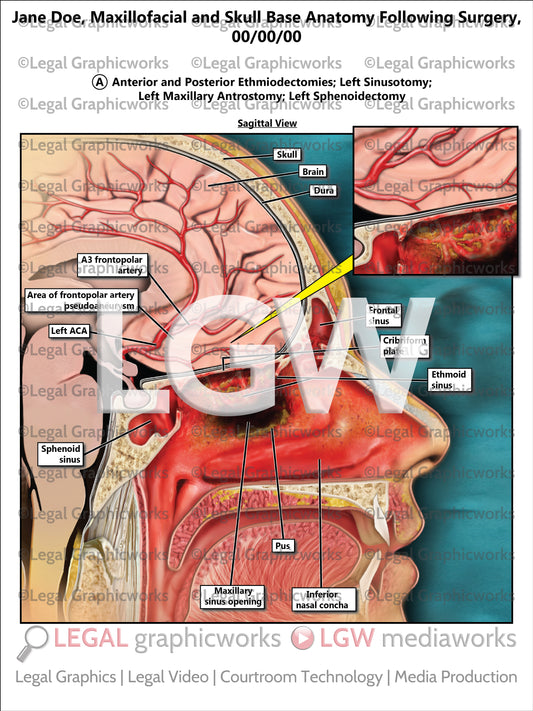 Maxillofacial and Skull Base Anatomy Following Surgery
