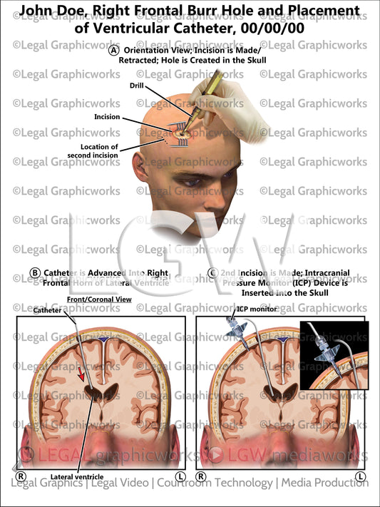 Right Frontal Burr Hole and Placement of Ventricular Catheter