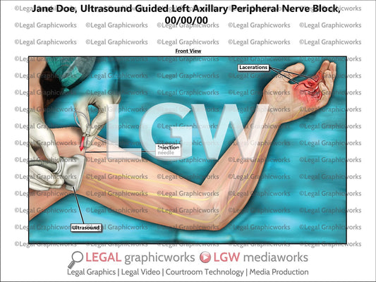 Ultrasound Guided Left Axillary Peripheral Nerve Block