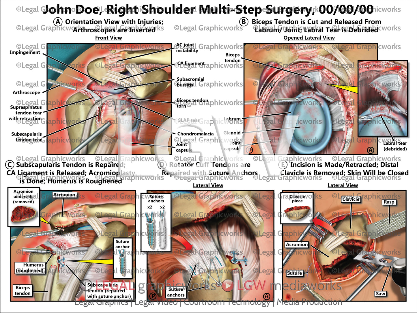 Right Shoulder Multi-Step Surgery