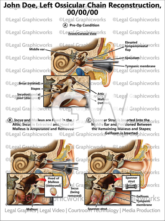 Left Ossicular Chain Reconstruction