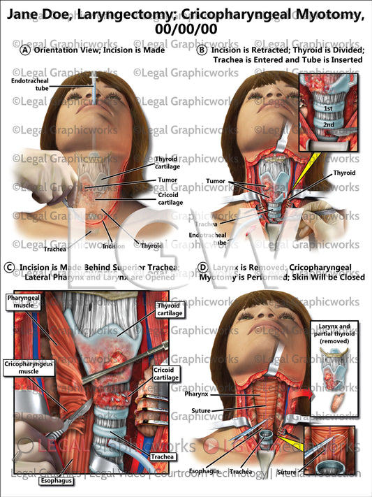 Laryngectomy; Cricopharyngeal Myotomy