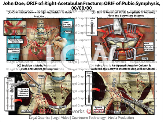 ORIF of Right Acetabular Fracture; ORIF of Pubic Symphysis
