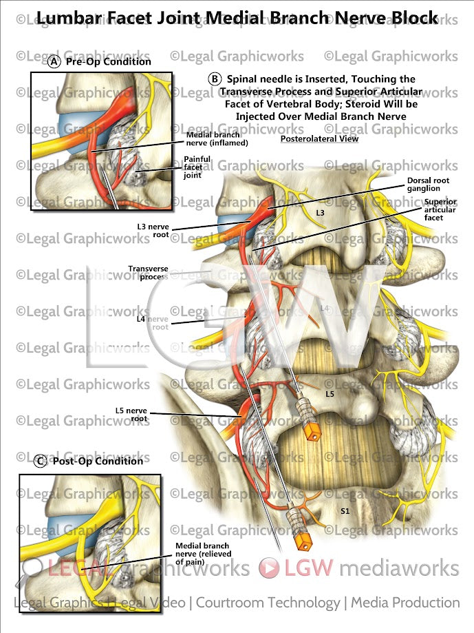 Lumbar Facet Joint Medial Branch Nerve Block