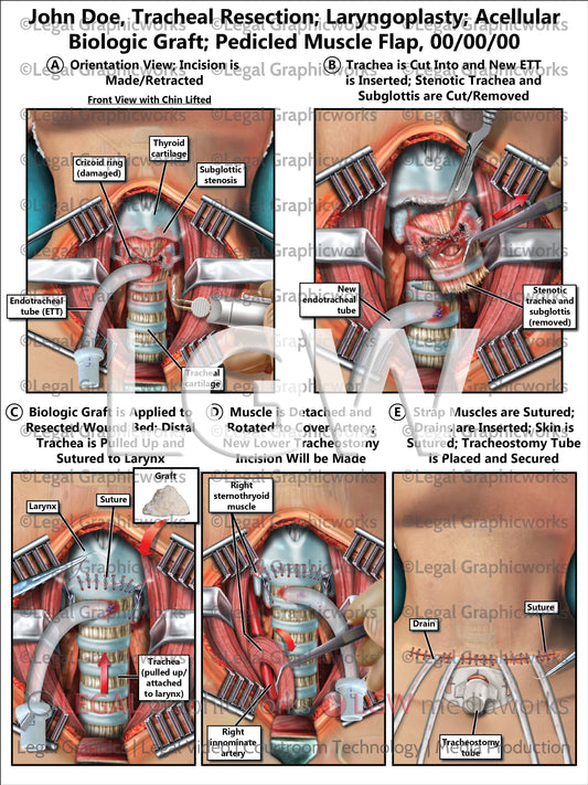 Tracheal Resection; Laryngoplasty; Acellular Biologic Graft; Pedicled Muscle Flap