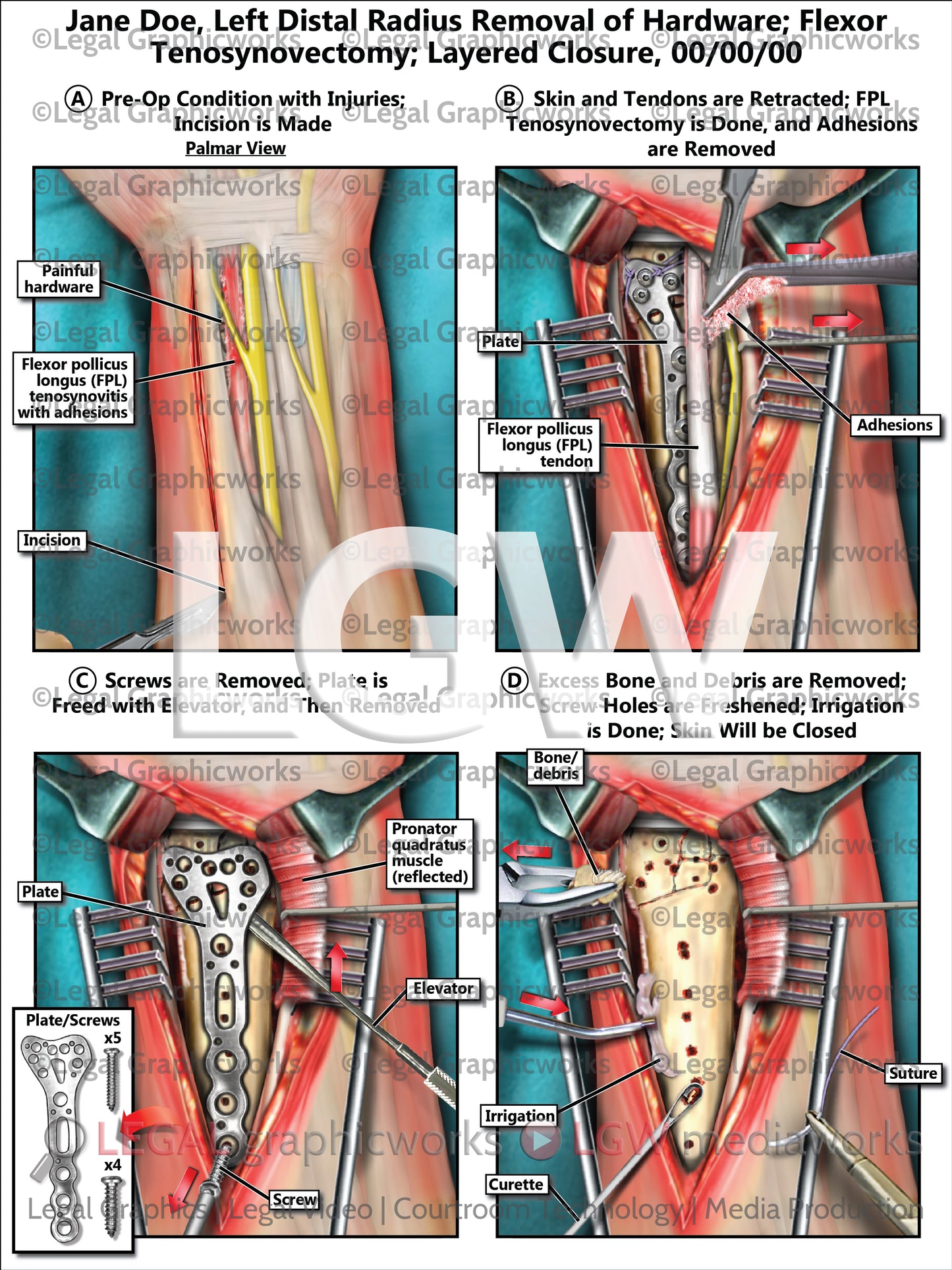 Left Distal Radius Removal of Hardware; Flexor Tenosynovectomy; Layered Closure