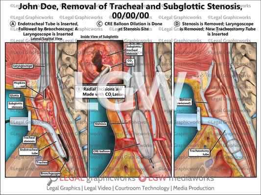 Removal of Tracheal and Subglottic Stenosis