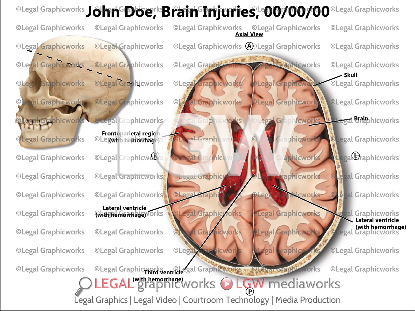 Brain Injuries