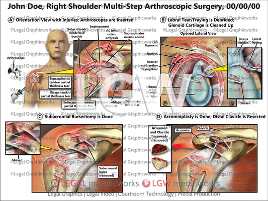 Right Shoulder Multi-Step Arthroscopic Surgery
