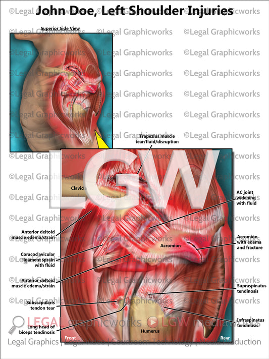 Left Shoulder Injuries