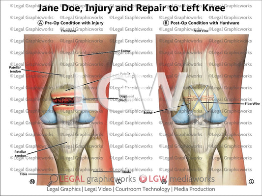 Injury and Repair to Left Knee